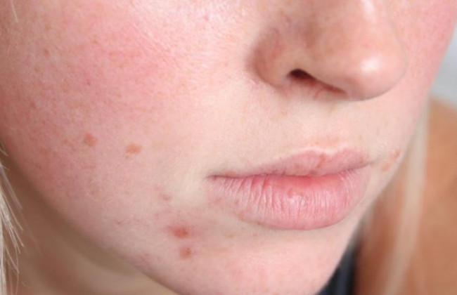 Врачи раскрыли 6 длительных симптомов штамма «Омикрон»