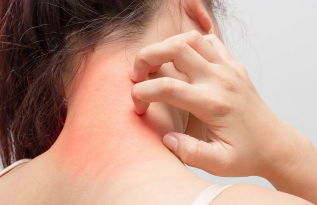 Стала известна причина появления сыпи при заражении «Омикроном»