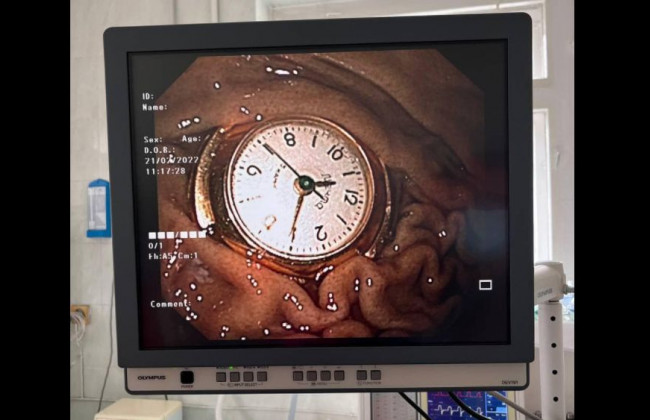 Проглотил часы: в Киеве врачи спасли 3-летнего ребенка