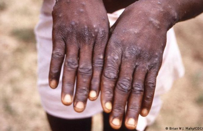 Оспа обезьян: в ВОЗ сделали важное заявление о вирусе