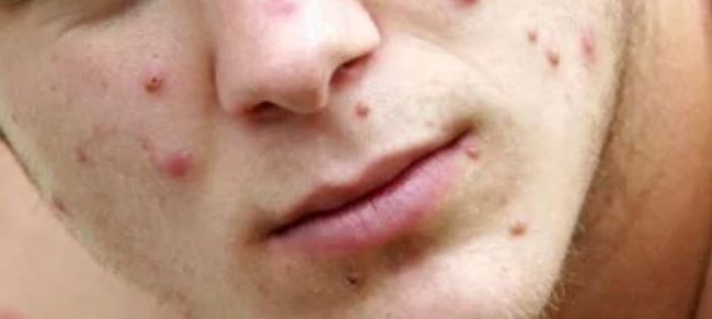 Назвали основной путь передачи оспы обезьян