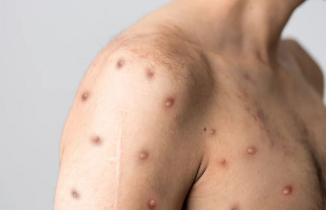 Назвали заразный период оспы обезьян