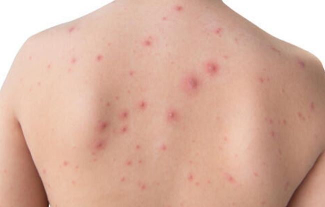 Оспа обезьян приближается к Украине: первый случай обнаружили в соседней стране