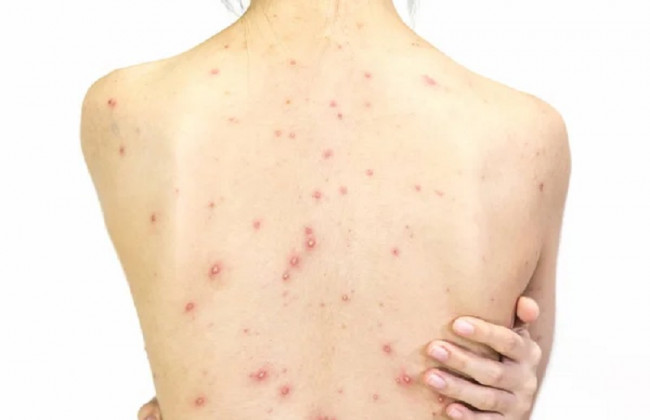 В ВОЗ рассказали, приведет ли вспышка оспы обезьян к пандемии