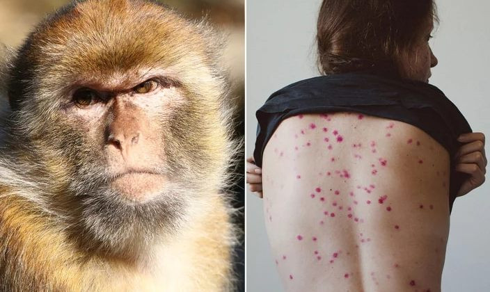Оспа обезьян официально объявлена пандемией