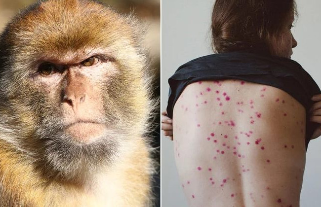 Оспа обезьян официально объявлена пандемией