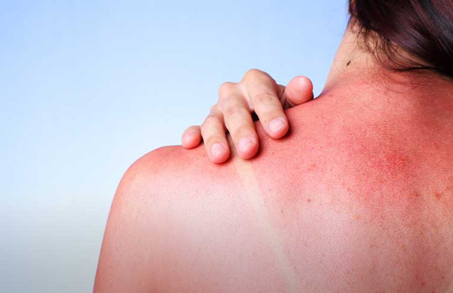 Солнечные ожоги: названы основные симптомы и способы защиты
