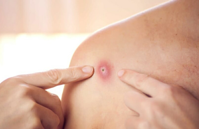 Оспа обезьян добралась до России: выявили первый случай заражения