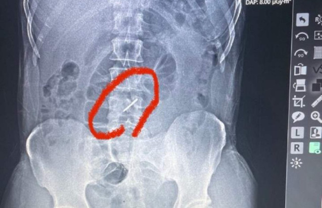 Навіть не підозрював: українець три тижні воював зі зламаним хребтом