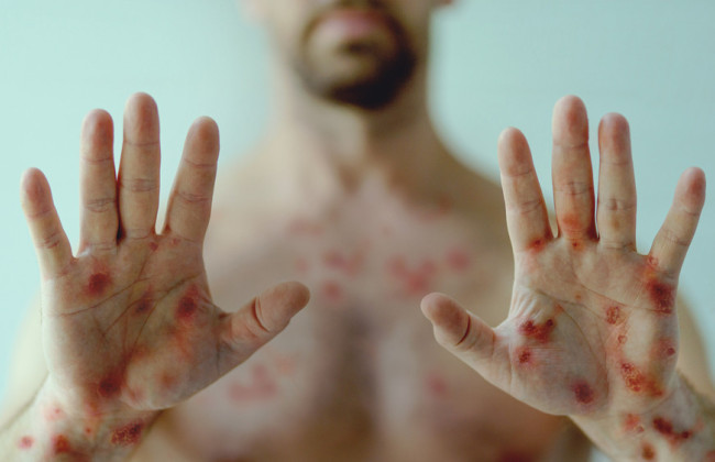 В Україні зареєстровано другий випадок віспи мавп, – МОЗ