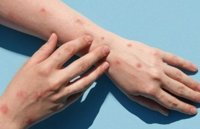 В Украине зафиксирован третий случай оспы обезьян – Игорь Кузин