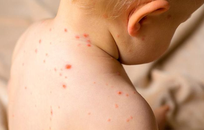 В Украине представили стандартизированный план готовности и реагирования на вспышку кори в случае его возникновения