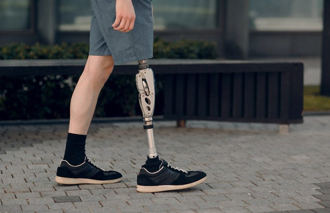 Як отримати безкоштовне протезування та інші засоби реабілітації: роз’яснення