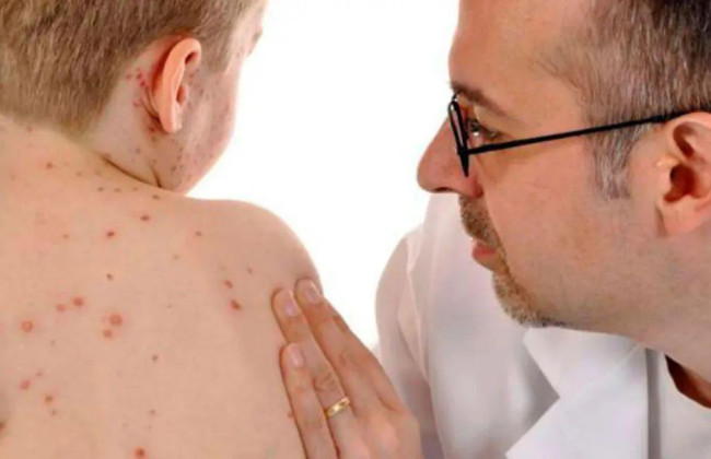 В Украине регистрируют случаи кори – в Минздраве бьют тревогу