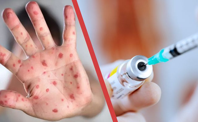 В Киеве призывают вакцинировать детей для предотвращения вспышки кори