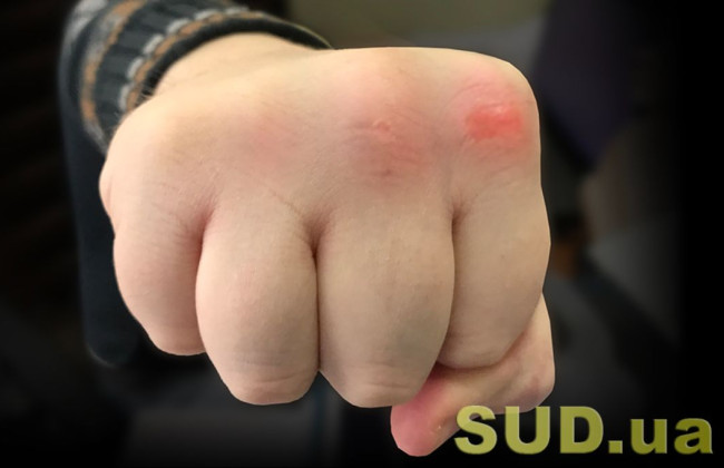 В Черкасской области будут судить мужчину, который палкой избил старосту общины