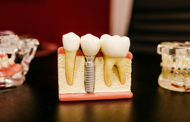 В Украине начали прием заявок от медучреждений для участия в проекте зубопротезирования ветеранов