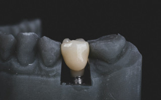 Военнослужащие могут бесплатно получить услуги по зубопротезированию, но есть условия