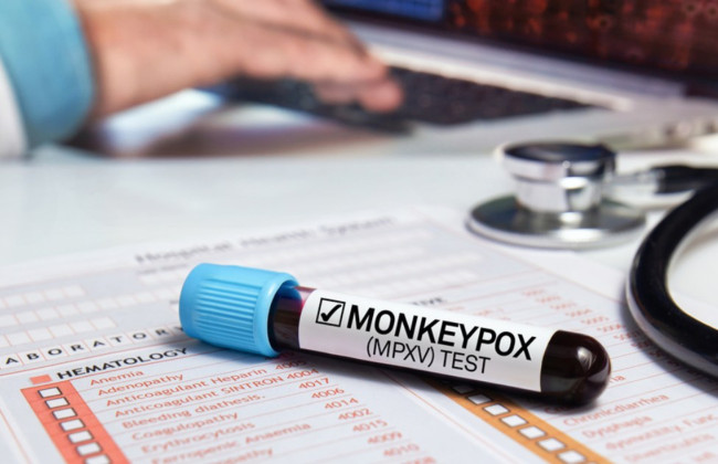 В Швеции зафиксировали первый случай заражения оспой обезьян за пределами Африки