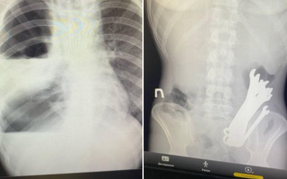 У Черкасах медики виявили у шлунку чоловіка шість гайкових ключів, фото