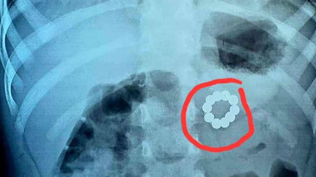 Во Франковске хирурги прооперировали трехлетнюю девочку, которая проглотила 21 магнит