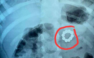 У Франківську хірурги прооперували трирічну дитину, яка ковтнула 21 магніт