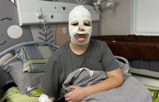 Во Львове с химическими ожогами госпитализировали троих детей из-за самодельных петард из TikTok