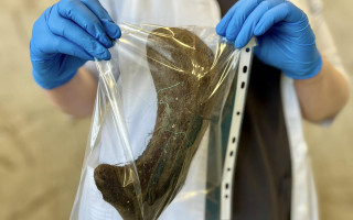 В Киеве успешно прооперировали 13-летнюю девочку после пятилетней привычки есть волосы