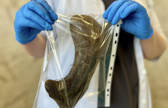 В Киеве успешно прооперировали 13-летнюю девочку после пятилетней привычки есть волосы