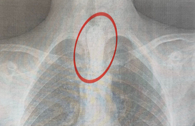 Во Львове врачи спасли 14-летнего парня, который подавился шашлыком