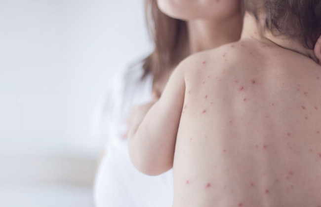 В Украине фиксируют рост заболеваемости корью, специалисты говорят — ситуация напряженная