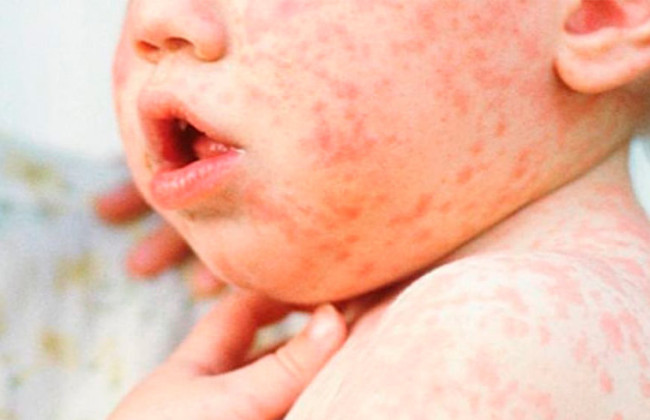 Украина среди лидеров по заболеваемости корью