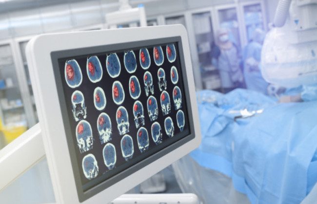 В Европе впервые в мозг человека вживили аппарат на основе ИИ