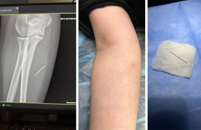 На Львівщині лікарі вилучили з тіла 13-річної дівчинки голку, яку сприймали за укус комахи