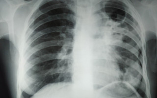 В Україні з’являються випадки позалегеневого туберкульозу – у ЦГЗ відповіли, чи існує сплеск захворюваності