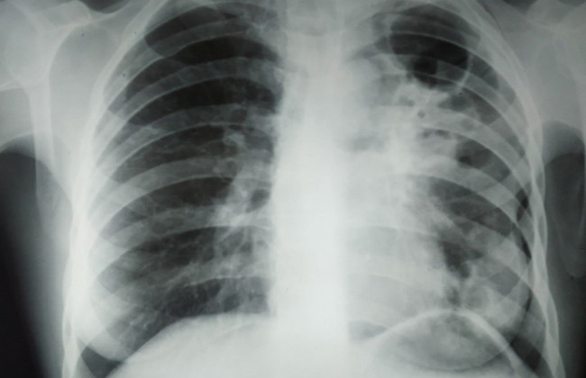 В Украине появляются случаи внелегочного туберкулеза – в ЦОЗ ответили, существует ли всплеск заболеваемости