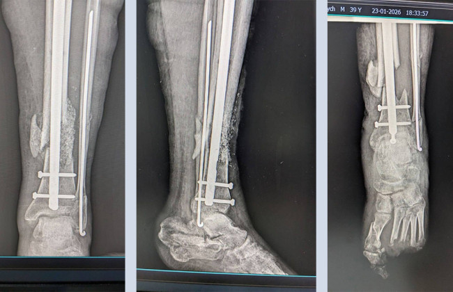На Прикарпатті військовому у районній лікарні відновили кістку за допомогою біоактивного скла