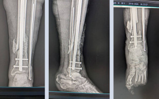 На Прикарпатье военному в районной больнице восстановили кость с помощью биоактивного стекла