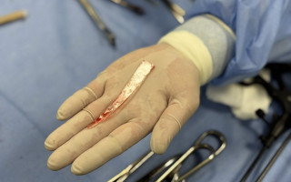 У Львові після атаки російських дронів у чоловіка в легенях застряг 10-сантиметровий шматок скла