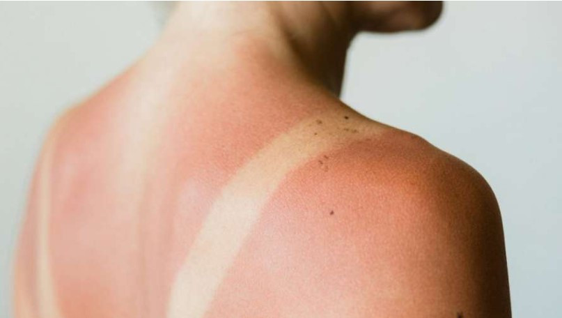 What to Do for Sunburn: First Aid, Symptoms, and How to Protect Your Skin