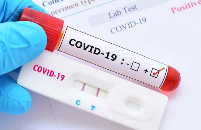 Україна закупить тест-системи на COVID-19 за програмою Світового банку