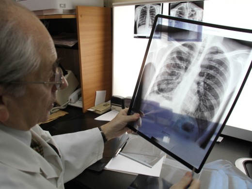 В Украине подготовили программу противодействия туберкулезу