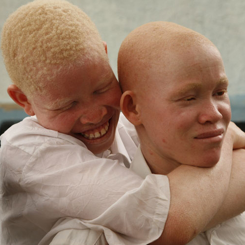 В Танзании за ритуальное убийство альбиноса 4 человека приговорены к смертной казни